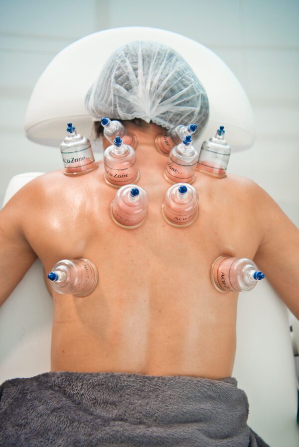 cupping Therapy