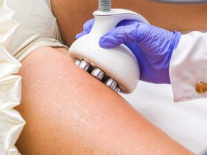 Tratamiento Venus Freeze Corporal para eliminar la piel de naranja