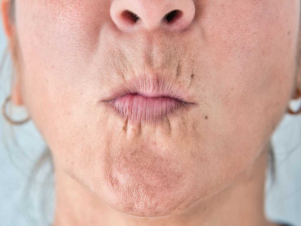 Imagen de tratamiento con botox en los labios