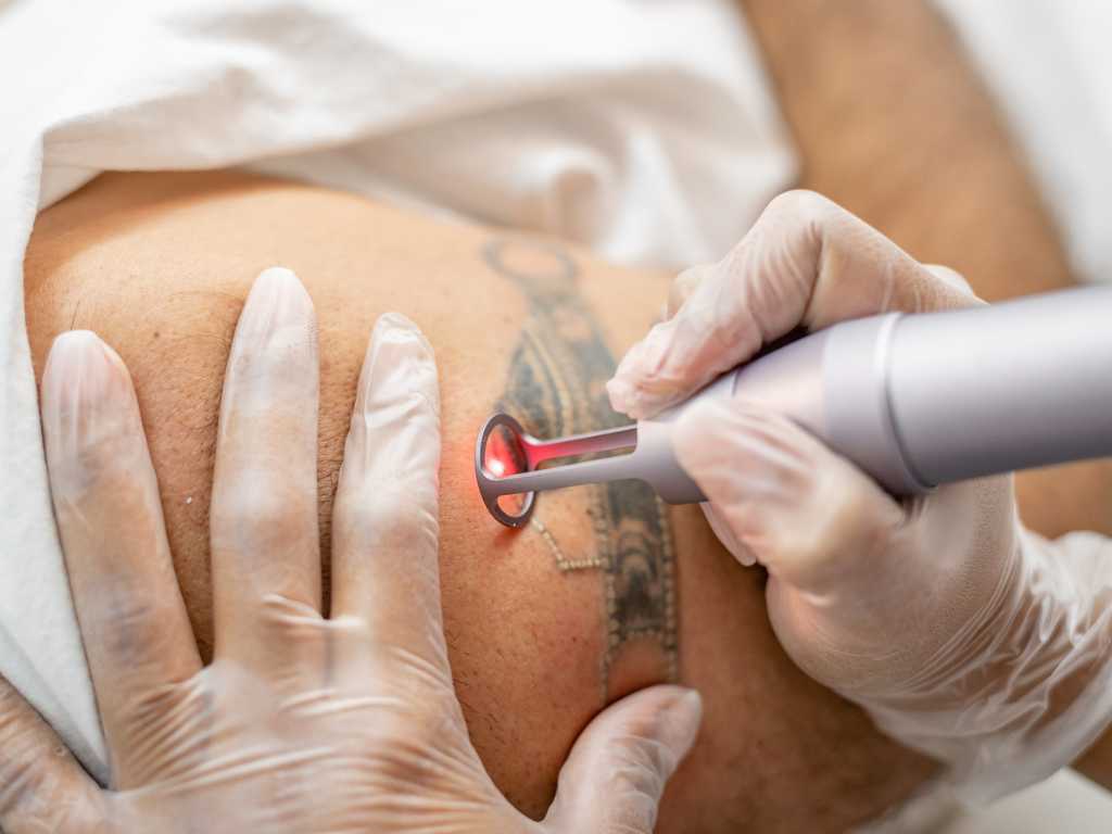 Imagen de tratamiento láser para remover tatuajes