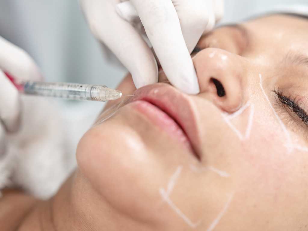 Imagen de tratamiento de aumento de labios con ácido hialurónico de relleno