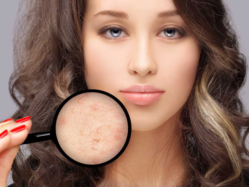 Imagen de mujer con cicatrices de acné